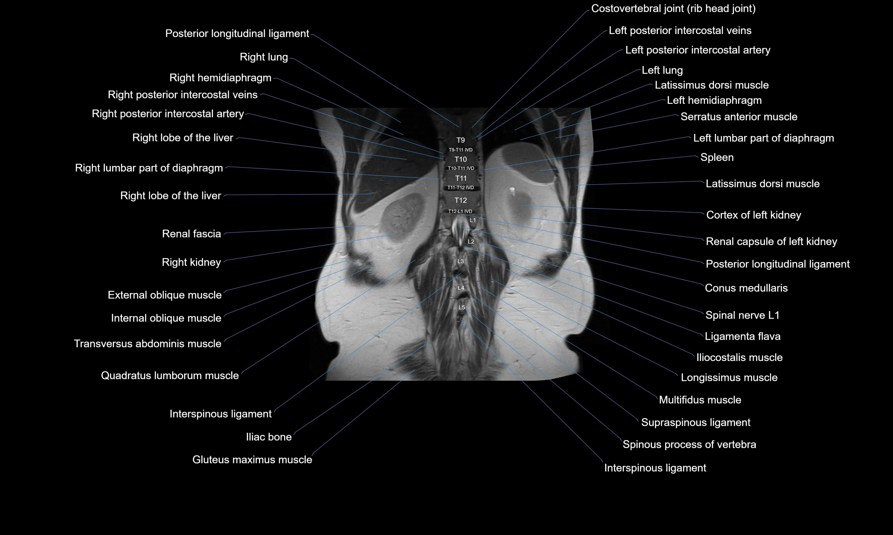MRI Abdomen axial cross sectional anatomy radiology  image-img-00001-00047.webp